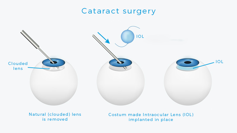 Betamedics - cataract surgery - IOL