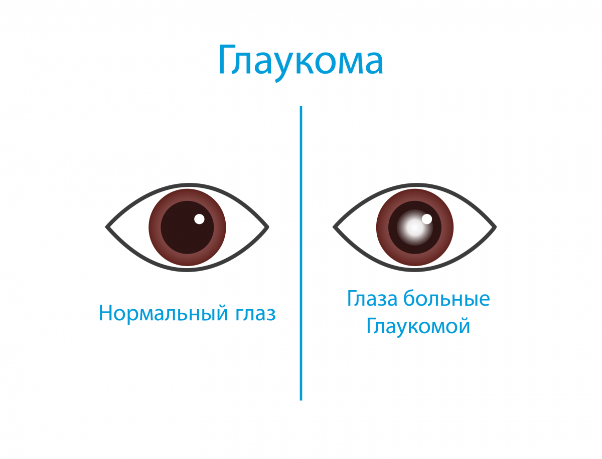 Betamedics - Glaucoma
