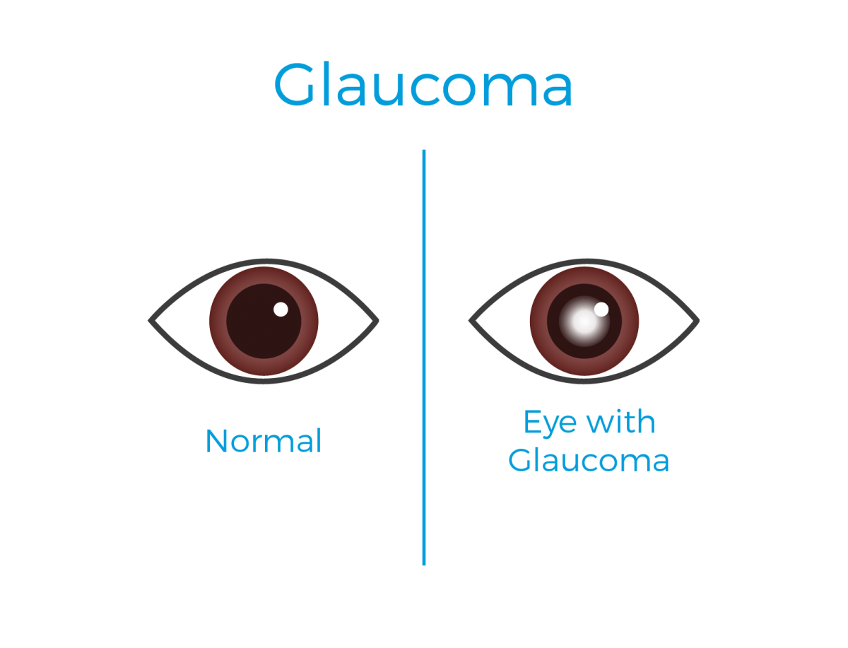 Betamedics - Glaucoma