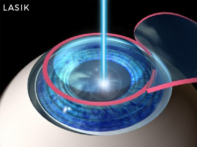 Betamedcis - laser eye surgery - LASIK