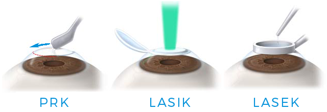 Betamedics - laser eye surgery - PRK, LASEK, LASIK